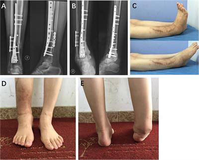 Case Report: Supramalleolar osteotomy to preserve joint function and delay the development of Charcot neuroarthropathy of the ankle